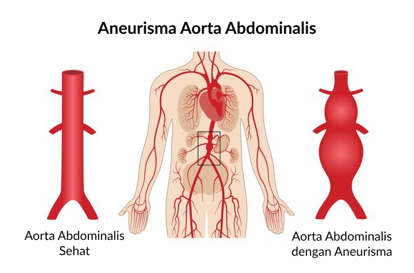 Aneurisma aorta abdominalis
