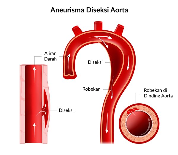 Aneurisma diseksi aorta