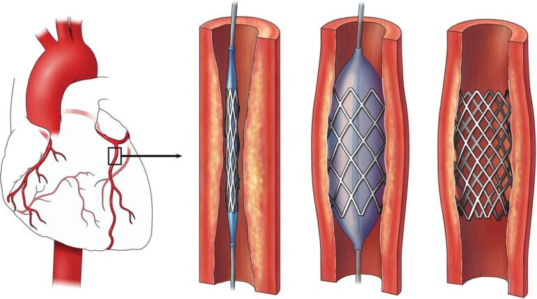 Heart with coronary arteries and stent placement in three stages: crimped stent, balloon inflation, expanded stent