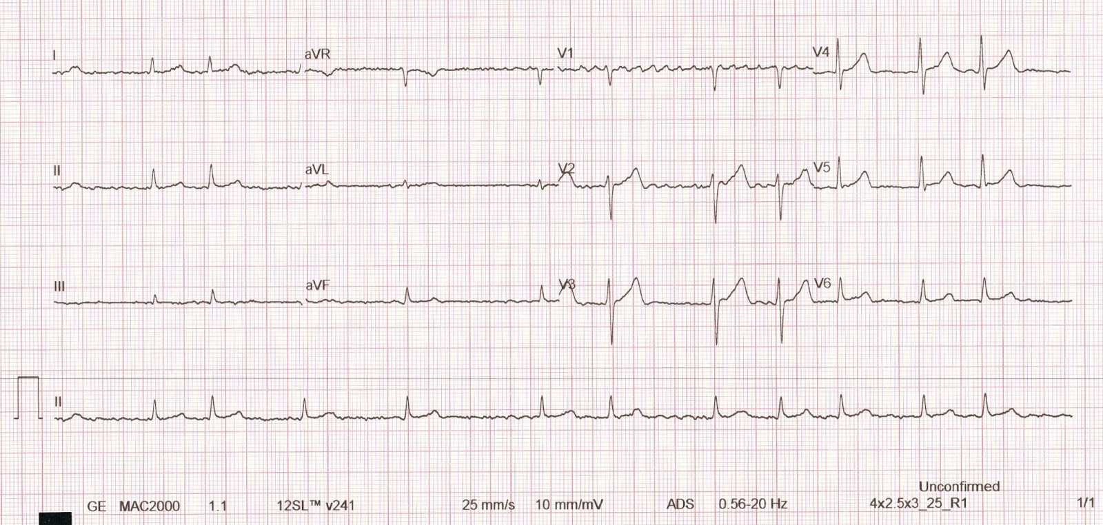 12-lead ECG tracing of the patient before the ablation procedure, with an irregular rhythm