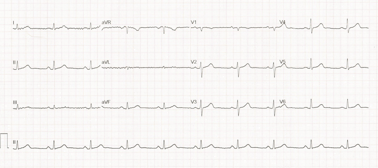 12-lead ECG tracing of the patient after the ablation procedure, with a regular rhythm