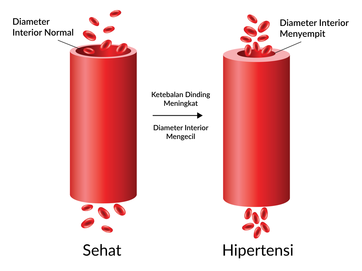 Ilustrasi Kondisi Tekanan Darah Normal dan Hipertensi (Tekanan Darah Tinggi)