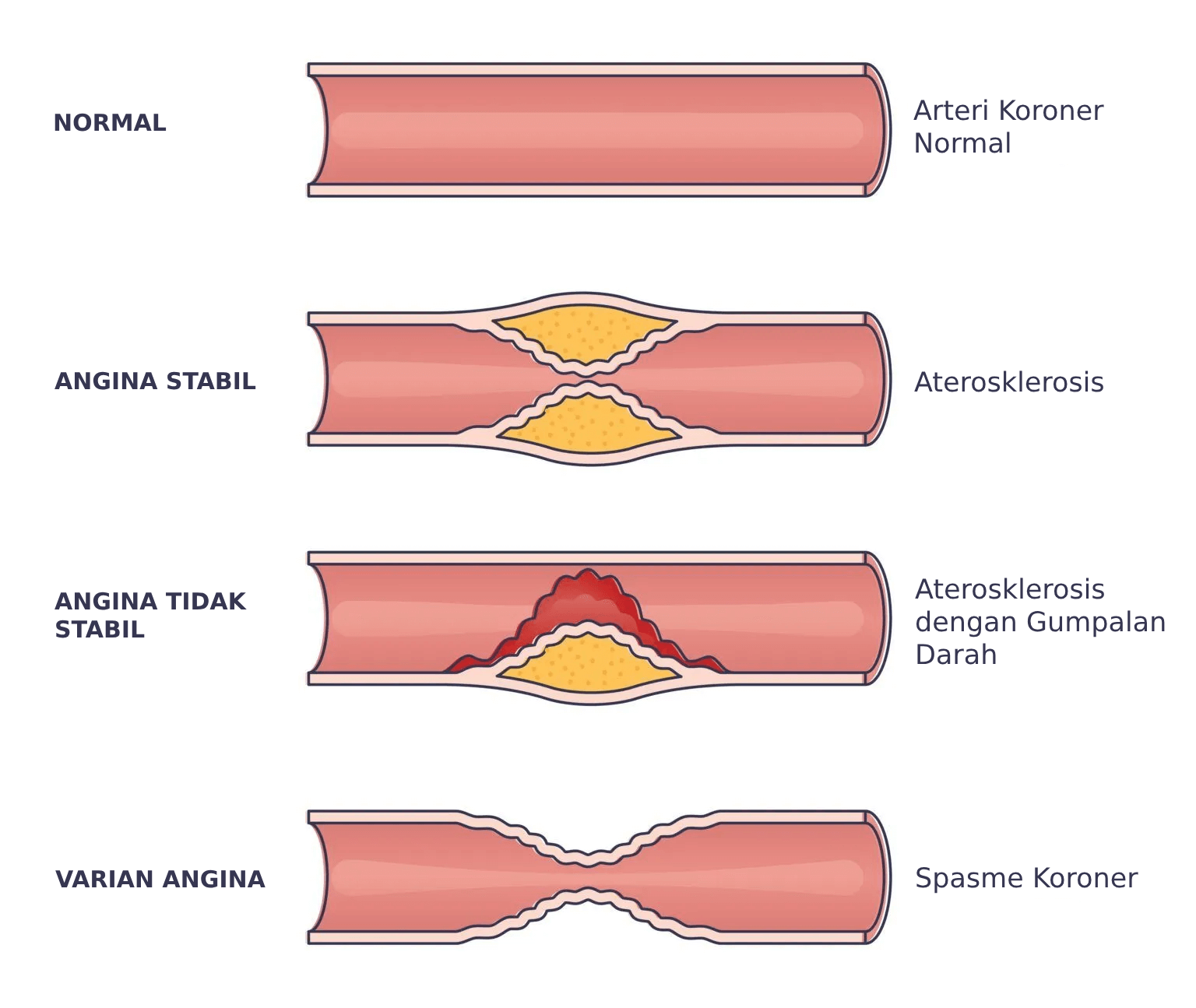 Ilustrasi jenis jenis angina