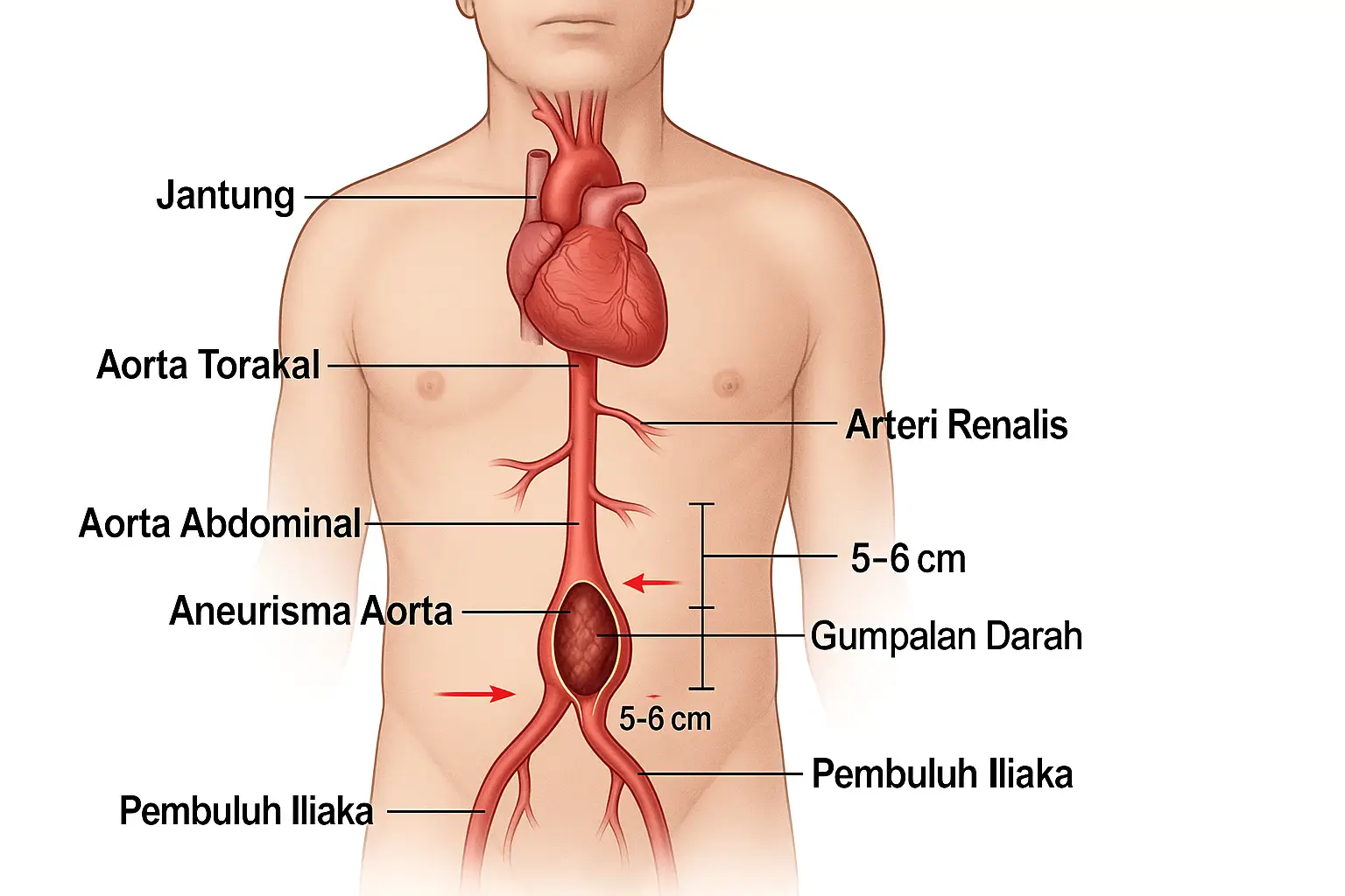 Ilustrasi Medis Aneurisma Aorta Abdominal
