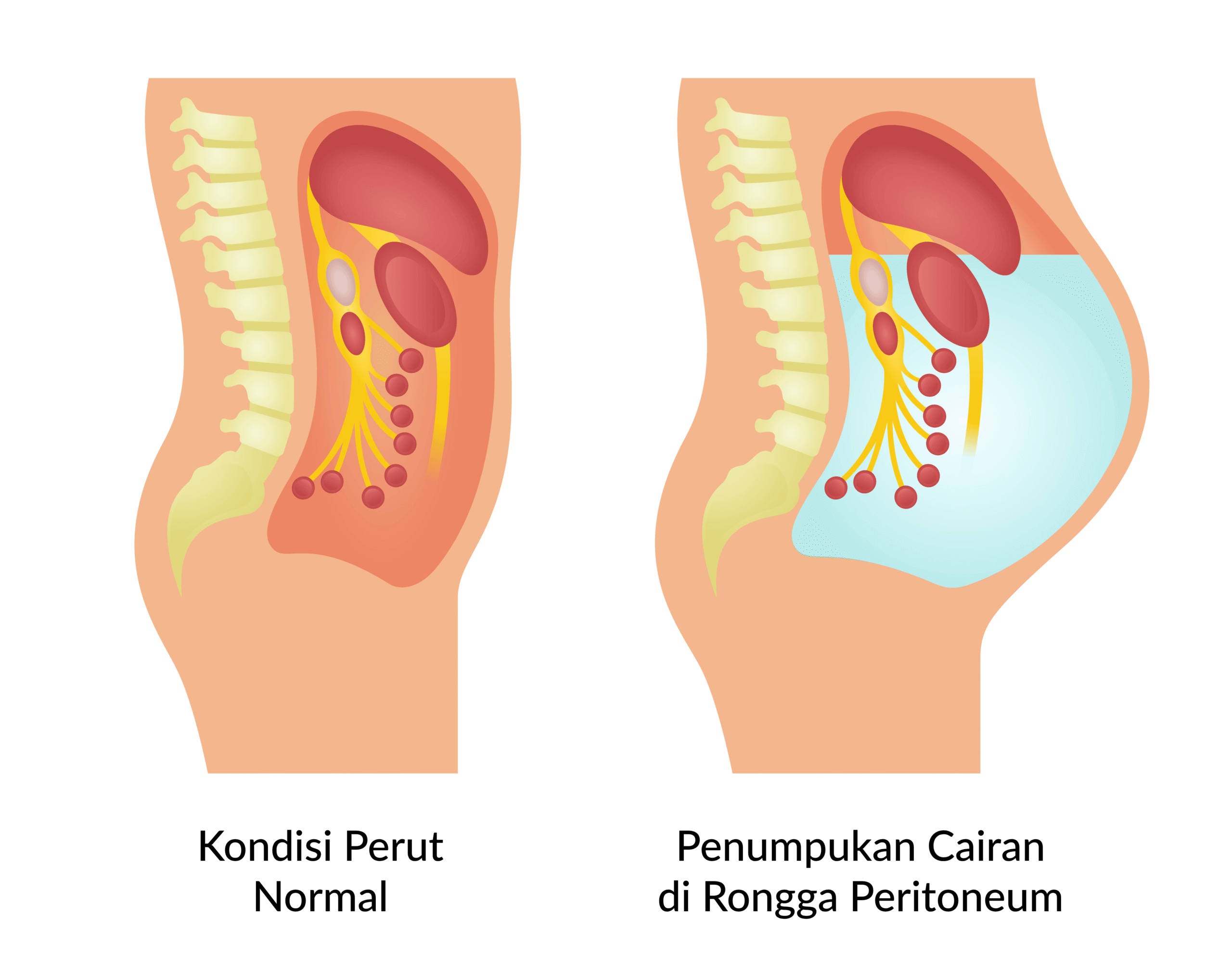 Perbandingan kondisi perut normal dan penumpukan cairan di rongga peritoneum pada asites.