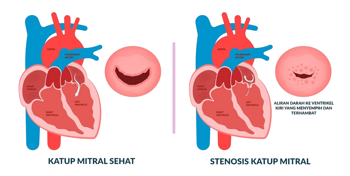 Gambar Ilustrasi: Jantung dengan Stenosis Katup Mitral