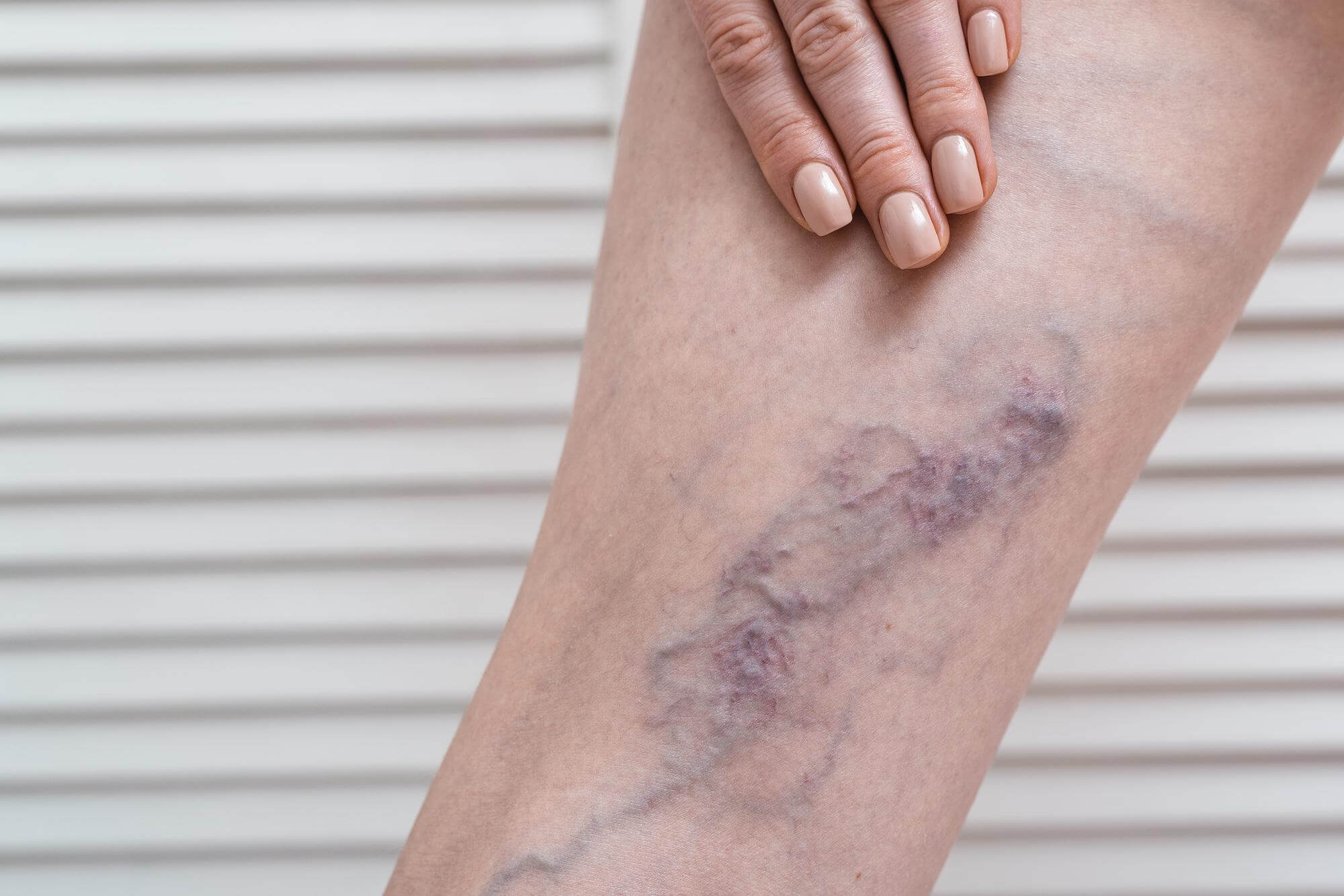 Penampakan varises pada kaki