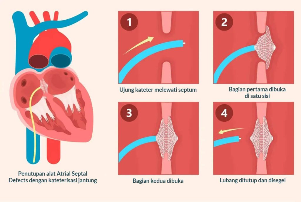 Penutupan penyakit jantung bawaan dengan teknik zero fluoroscopy